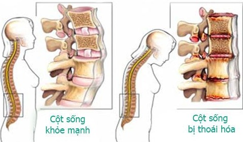 Bệnh thoái hóa cột sống gây đau lưng