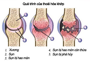 Bệnh thoái hóa khớp gây đau nhức